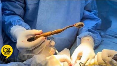 استخراج فرشاة أسنان من معدة مريضة في مستشفى ابن سينا